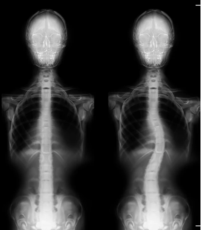 Scoliosis Treatment In Ponte Vedra Beach